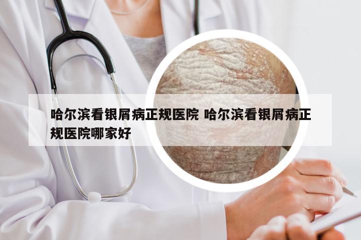 哈尔滨看银屑病正规医院 哈尔滨看银屑病正规医院哪家好