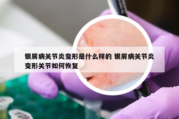 银屑病关节炎变形是什么样的 银屑病关节炎变形关节如何恢复