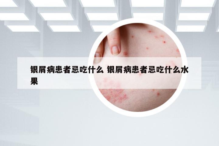 银屑病患者忌吃什么 银屑病患者忌吃什么水果