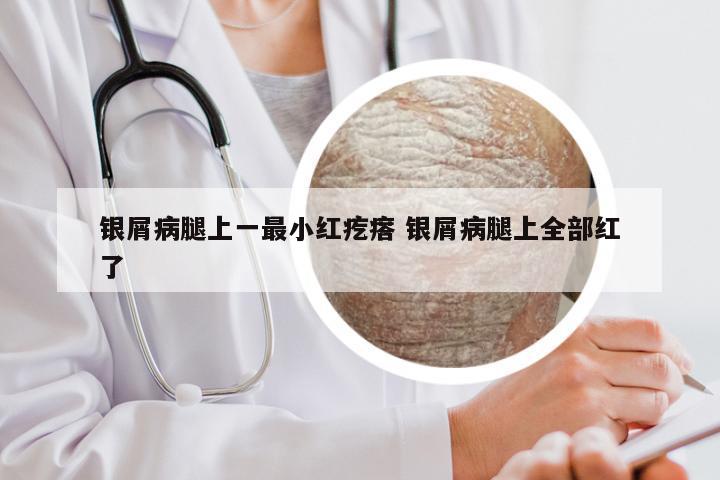 银屑病腿上一最小红疙瘩 银屑病腿上全部红了