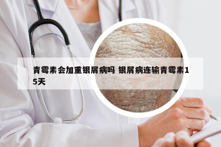 青霉素会加重银屑病吗 银屑病连输青霉素15天