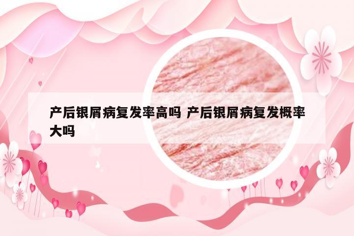 产后银屑病复发率高吗 产后银屑病复发概率大吗