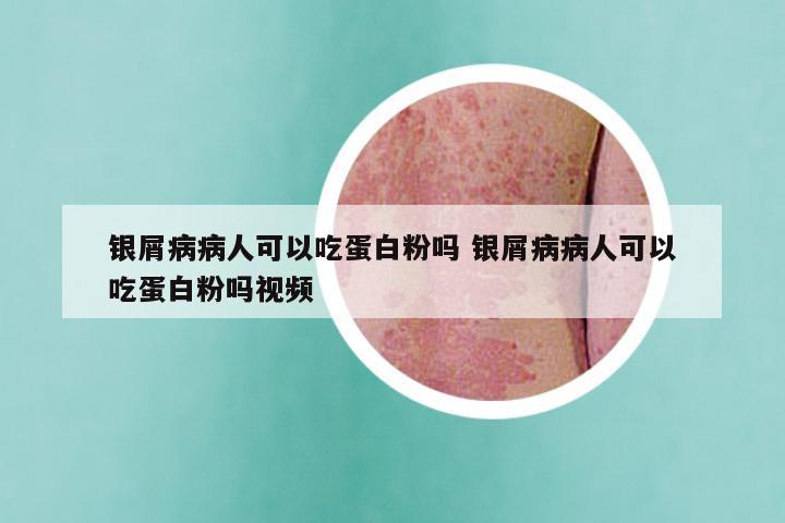 银屑病病人可以吃蛋白粉吗 银屑病病人可以吃蛋白粉吗视频
