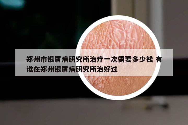 郑州市银屑病研究所治疗一次需要多少钱 有谁在郑州银屑病研究所治好过