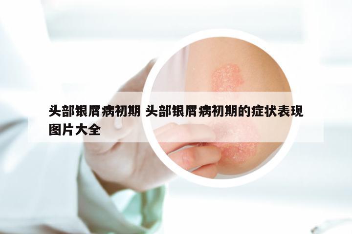 头部银屑病初期 头部银屑病初期的症状表现图片大全