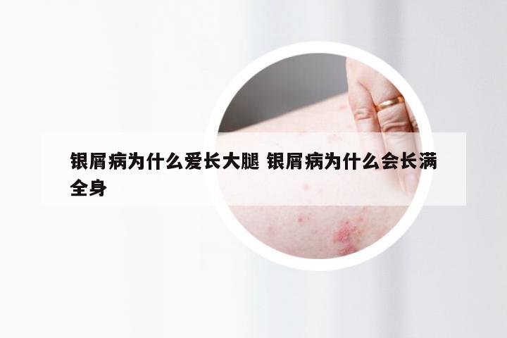 银屑病为什么爱长大腿 银屑病为什么会长满全身