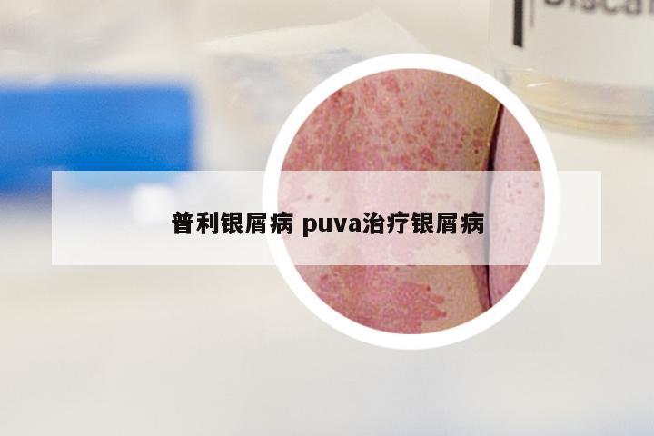 普利银屑病 puva治疗银屑病