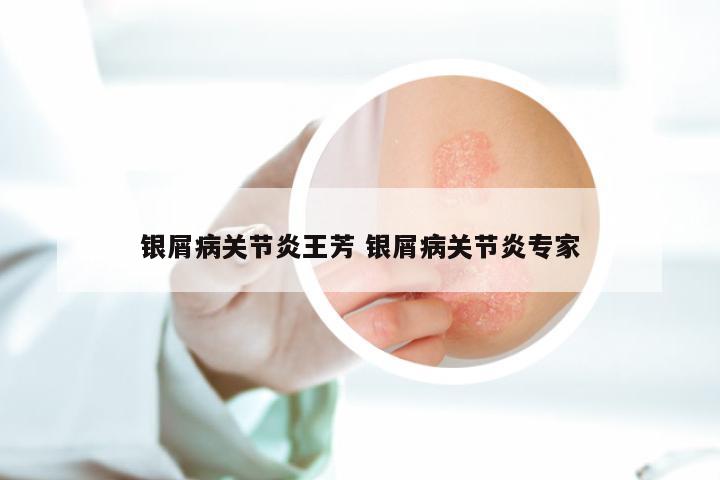 银屑病关节炎王芳 银屑病关节炎专家