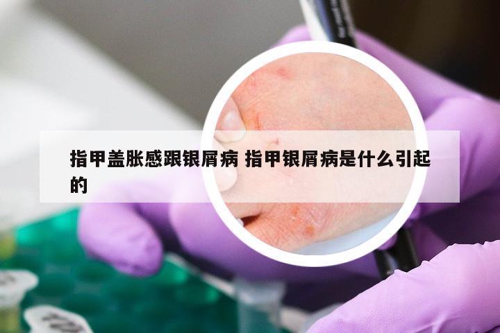 指甲盖胀感跟银屑病 指甲银屑病是什么引起的