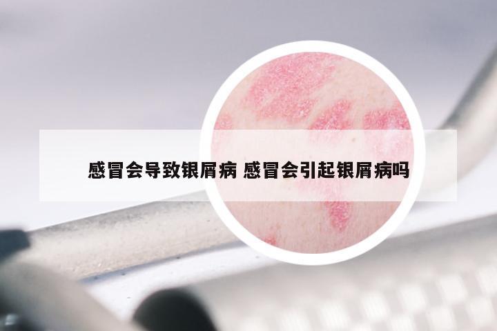 感冒会导致银屑病 感冒会引起银屑病吗
