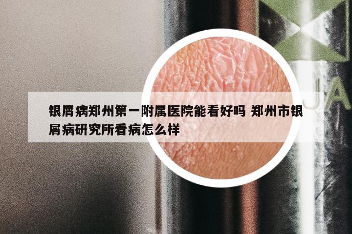 银屑病郑州第一附属医院能看好吗 郑州市银屑病研究所看病怎么样