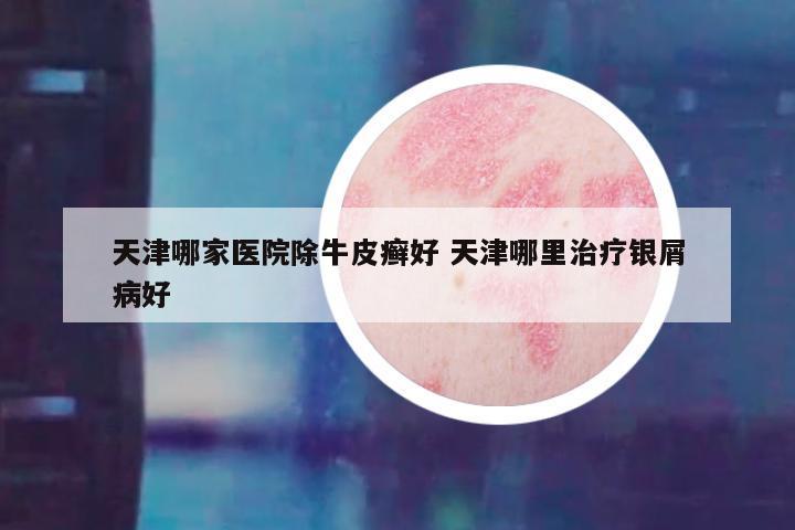 天津哪家医院除牛皮癣好 天津哪里治疗银屑病好