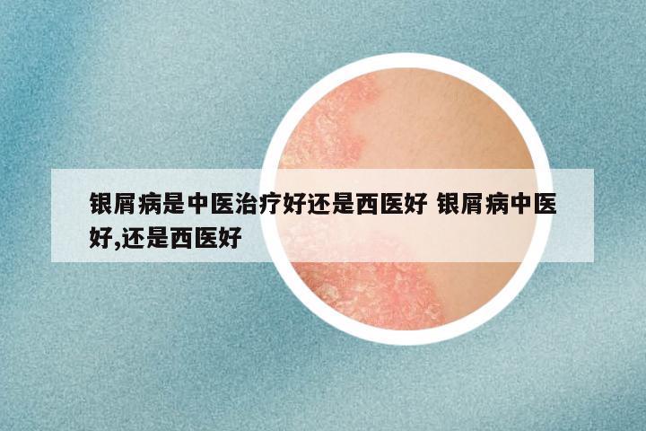 银屑病是中医治疗好还是西医好 银屑病中医好,还是西医好