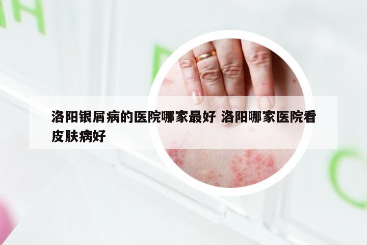 洛阳银屑病的医院哪家最好 洛阳哪家医院看皮肤病好