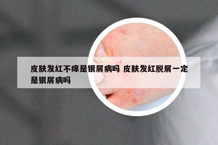 皮肤发红不痒是银屑病吗 皮肤发红脱屑一定是银屑病吗