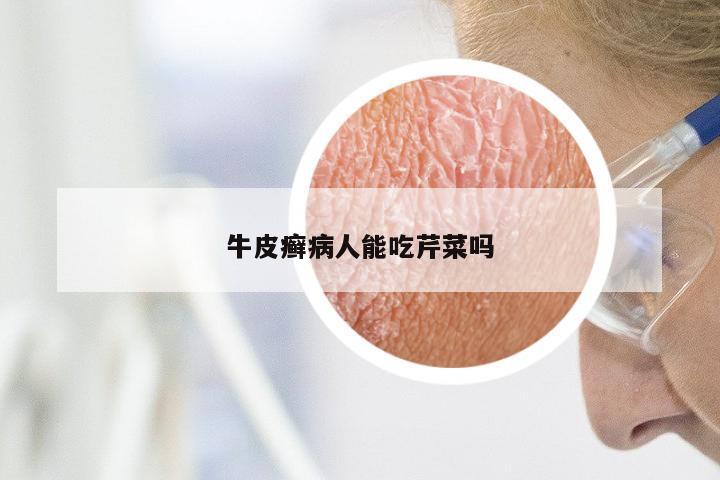 牛皮癣病人能吃芹菜吗