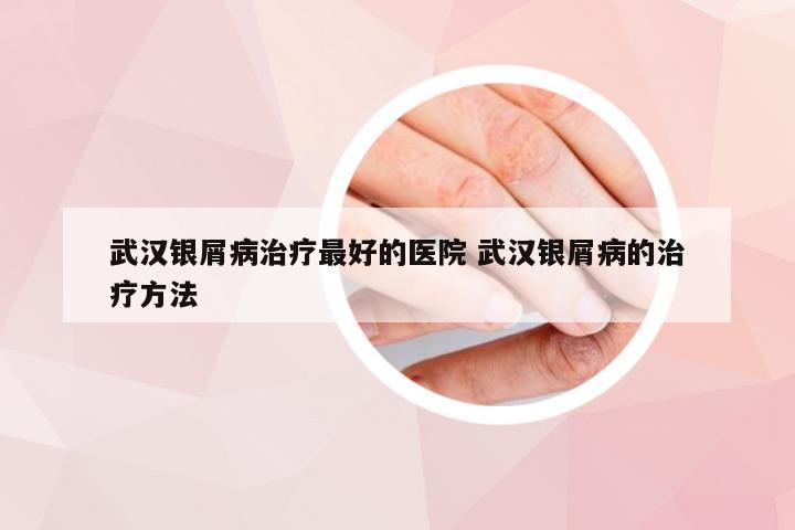 武汉银屑病治疗最好的医院 武汉银屑病的治疗方法