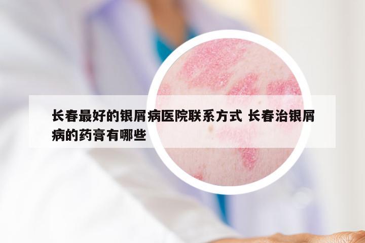 长春最好的银屑病医院联系方式 长春治银屑病的药膏有哪些