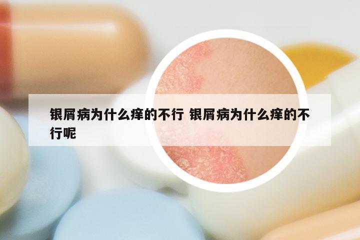 银屑病为什么痒的不行 银屑病为什么痒的不行呢