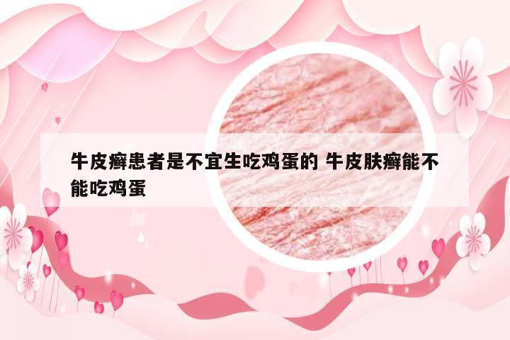 牛皮癣患者是不宜生吃鸡蛋的 牛皮肤癣能不能吃鸡蛋
