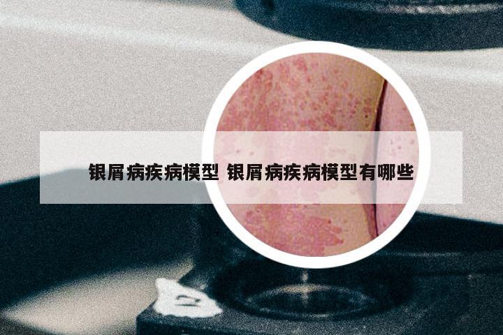 银屑病疾病模型 银屑病疾病模型有哪些