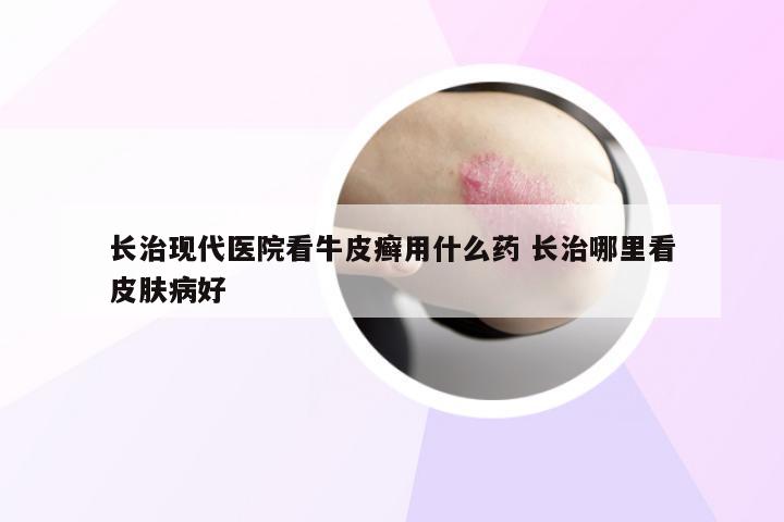 长治现代医院看牛皮癣用什么药 长治哪里看皮肤病好