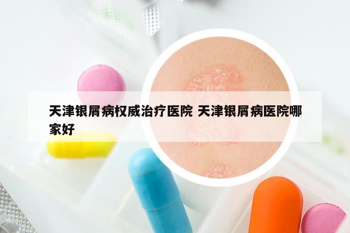 天津银屑病权威治疗医院 天津银屑病医院哪家好