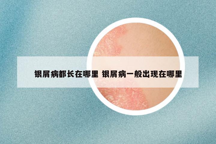 银屑病都长在哪里 银屑病一般出现在哪里