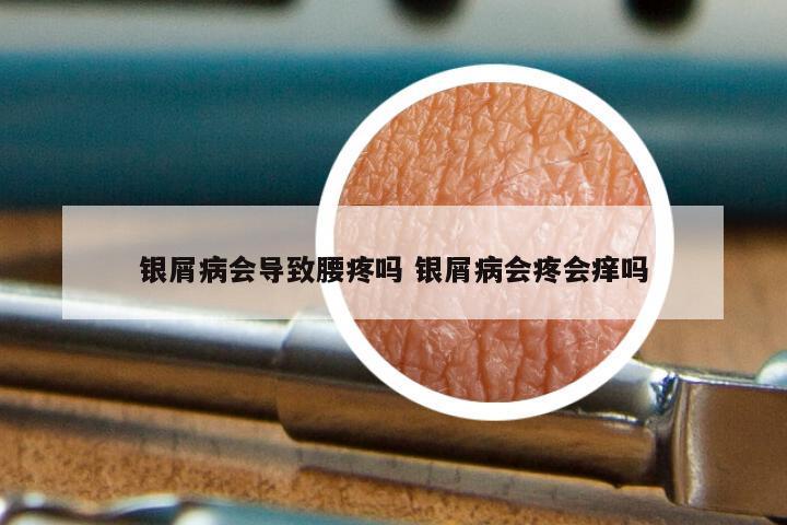 银屑病会导致腰疼吗 银屑病会疼会痒吗
