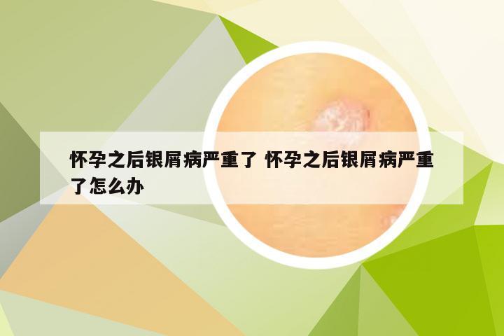 怀孕之后银屑病严重了 怀孕之后银屑病严重了怎么办