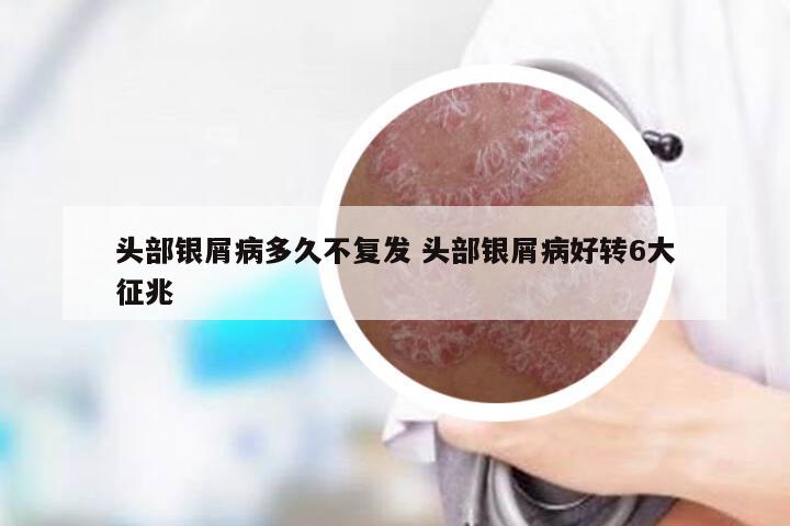 头部银屑病多久不复发 头部银屑病好转6大征兆