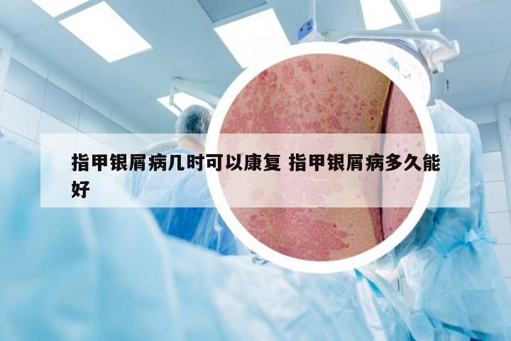 指甲银屑病几时可以康复 指甲银屑病多久能好