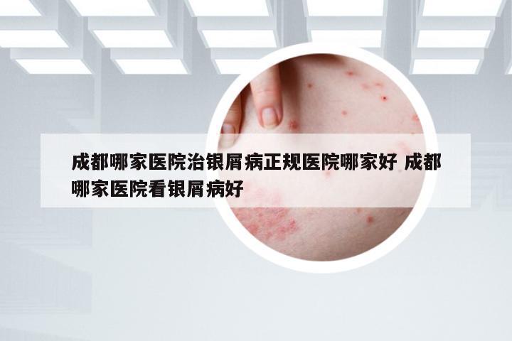 成都哪家医院治银屑病正规医院哪家好 成都哪家医院看银屑病好
