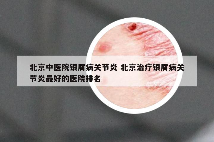 北京中医院银屑病关节炎 北京治疗银屑病关节炎最好的医院排名