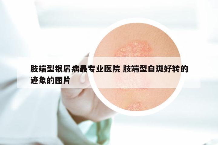 肢端型银屑病最专业医院 肢端型白斑好转的迹象的图片