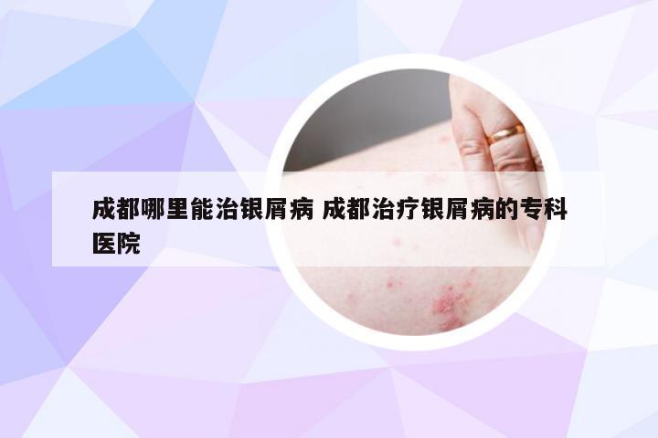 成都哪里能治银屑病 成都治疗银屑病的专科医院