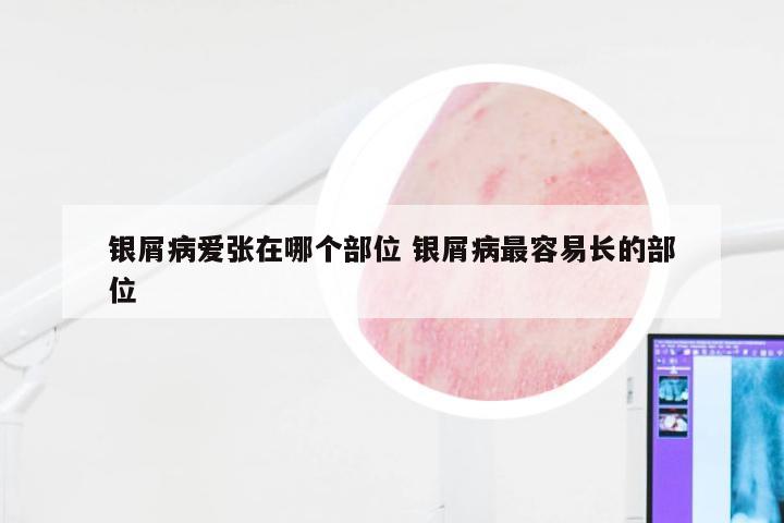 银屑病爱张在哪个部位 银屑病最容易长的部位