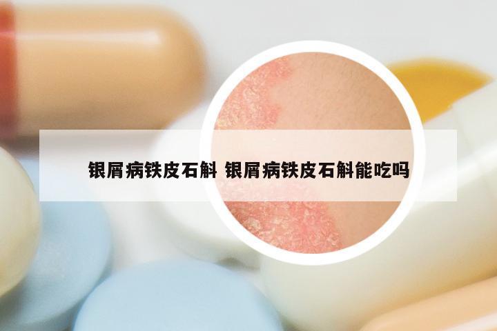 银屑病铁皮石斛 银屑病铁皮石斛能吃吗