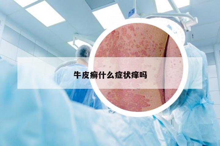 牛皮癣什么症状痒吗