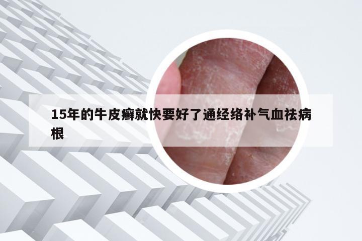 15年的牛皮癣就快要好了通经络补气血祛病根