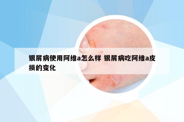 银屑病使用阿维a怎么样 银屑病吃阿维a皮损的变化