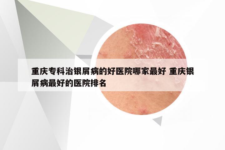 重庆专科治银屑病的好医院哪家最好 重庆银屑病最好的医院排名