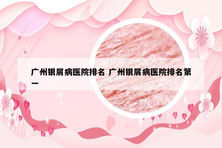 广州银屑病医院排名 广州银屑病医院排名第一