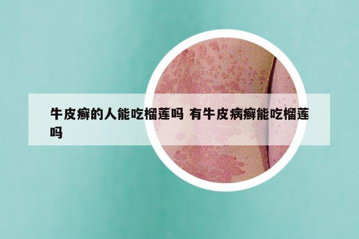 牛皮癣的人能吃榴莲吗 有牛皮病癣能吃榴莲吗