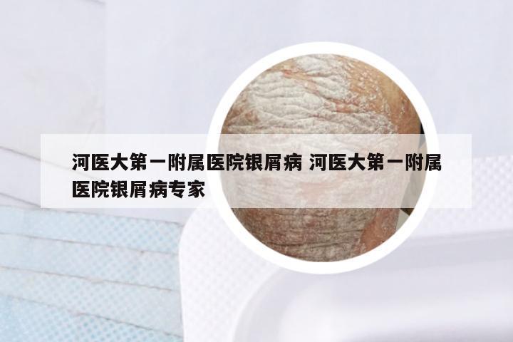 河医大第一附属医院银屑病 河医大第一附属医院银屑病专家