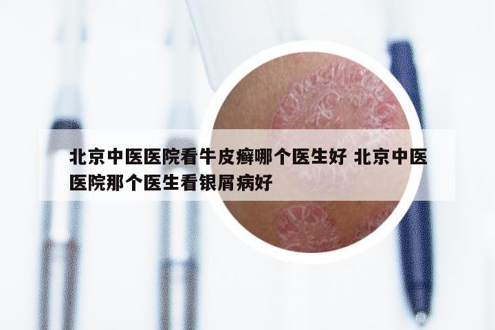 北京中医医院看牛皮癣哪个医生好 北京中医医院那个医生看银屑病好