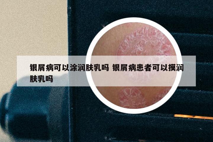 银屑病可以涂润肤乳吗 银屑病患者可以摸润肤乳吗