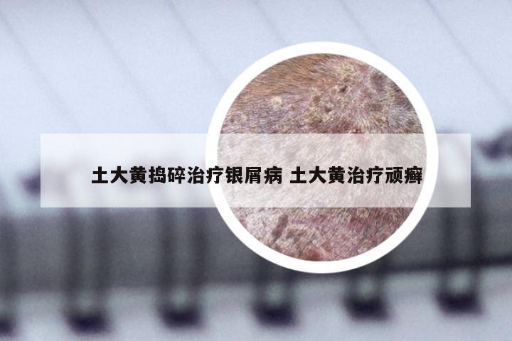 土大黄捣碎治疗银屑病 土大黄治疗顽癣