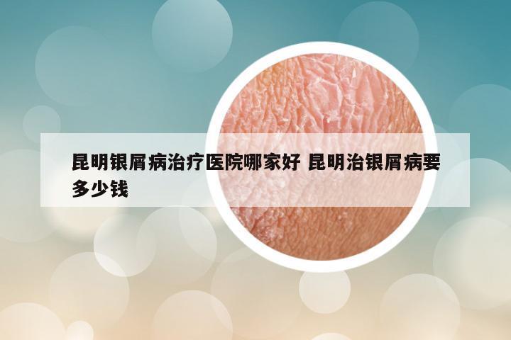 昆明银屑病治疗医院哪家好 昆明治银屑病要多少钱