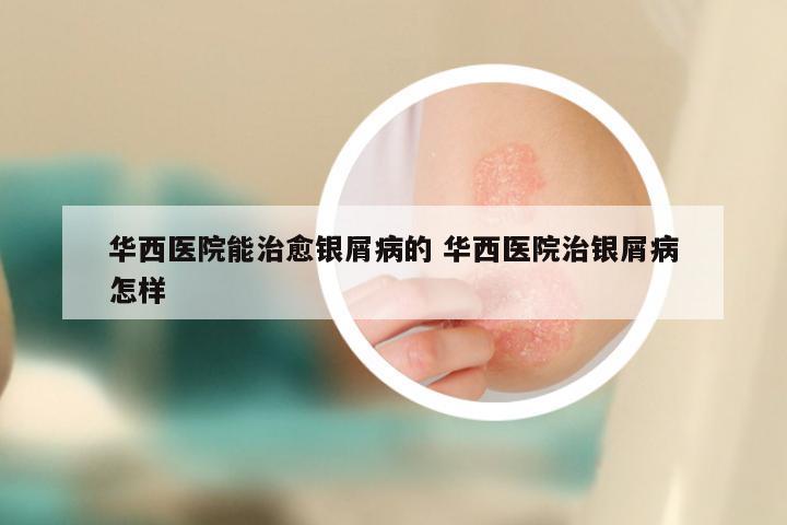 华西医院能治愈银屑病的 华西医院治银屑病怎样